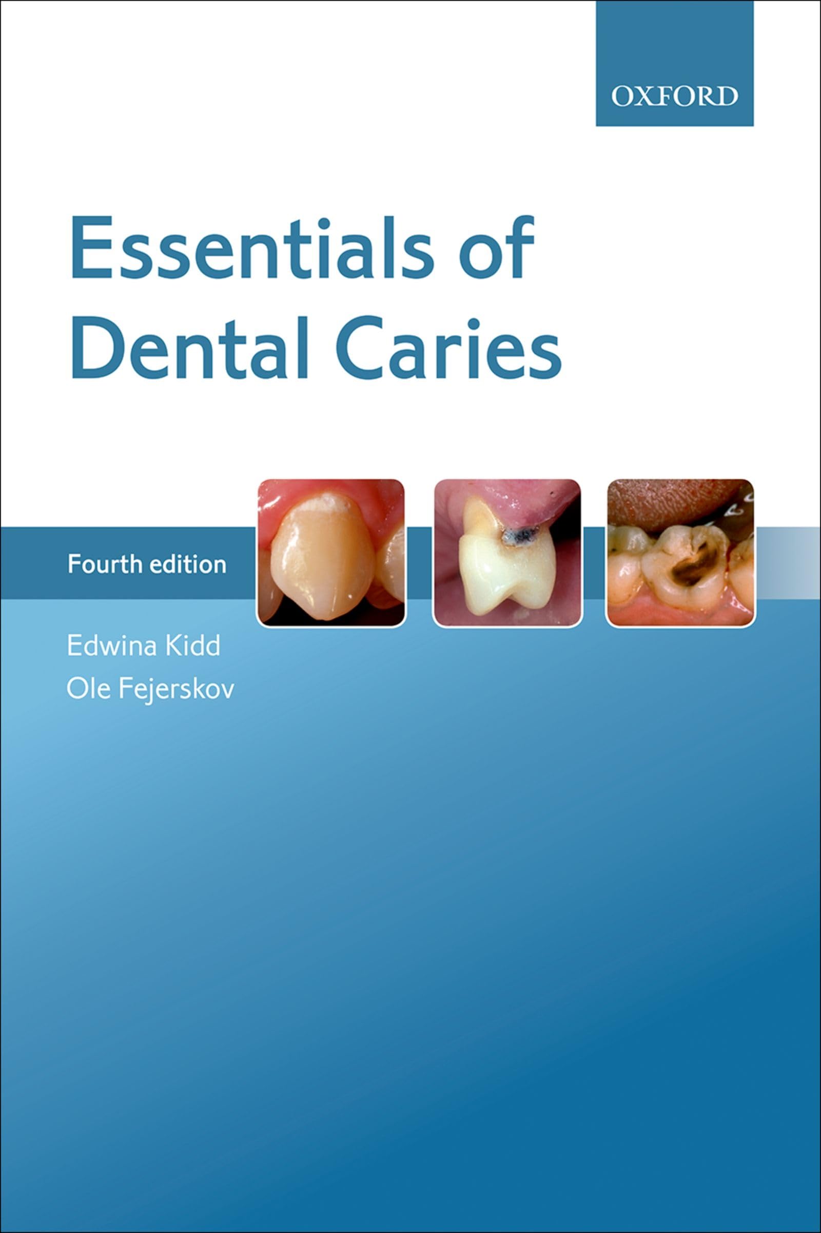 Buy Essentials of Dental Caries: A patient-centred approach Book